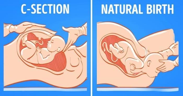 Normal Delivery vs. C-Section: Key Differences Explained